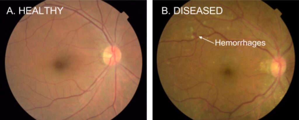 Diabetic Eye Diseases, What Are They? | Swast Eye